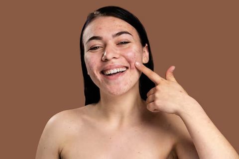 Acne Remedies and Causes: Essential Information for Healthy Skin